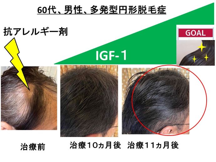 円形脱毛症　病院